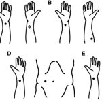 A series of hands showing acupuncture points